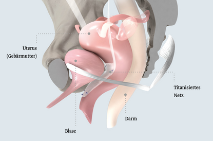 Beckenboden nach laparoskopisch-lateraler Suspension nach Dubuisson Eine anatomische Darstellung des menschlichen Beckens mit markierten Organen: Uterus, Blase, Darm und titanisierte Netze. Die farbigen Elemente zeigen die verschiedenen Organe und ihre Position im Beckenbereich.