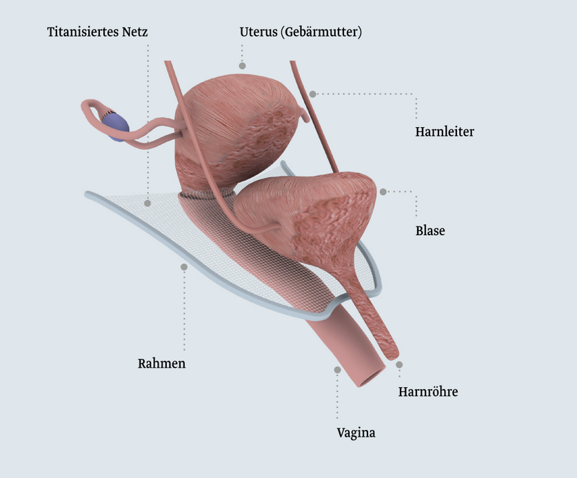 Positionierung des SRS Implantats Die Abbildung zeigt eine schematische Darstellung des weiblichen Unterleibs, einschließlich Uterus (Gebärmutter), Blase, Harnleiter, Harnröhre und Vagina, sowie ein titanisertes Netz zur Unterstützung. Die einzelnen Teile sind beschriftet, um ihre Funktion zu verdeutlichen.