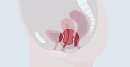 Uterusprolaps im weiblichen Beckenboden Schematische Darstellung eines menschlichen Fortpflanzungssystems, das innere Organe und Strukturen zeigt. Im Fokus steht ein roter Bereich, der Gebärmutter und Eileiter darstellt. Die Gebärmutter hat sich in die Vagina gesenkt.