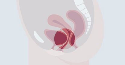 Zystozele im weiblichen Beckenboden Eine schematische Darstellung eines weiblichen Sexualorgans mit den inneren Strukturen, einschließlich der Vagina, des Gebärmutterhalses und der Gebärmutter. Die Blase hat sich nach hinten in Richtung Vagina gewölbt. Die Farben sind in verschiedenen Rosa- und Rottönen gehalten, um die anatomischen Teile zu verdeutlichen.