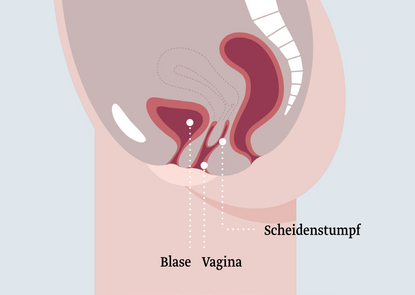 Beckenboden mit Scheidenstumpf nach Hysterektomie Eine anatomische Darstellung des weiblichen Unterleibs, die die Blase, die Vagina und den Scheidenstumpf zeigt. Die einzelnen Teile sind farblich hervorgehoben und beschriftet, um ihre Lage und Beziehung zueinander zu verdeutlichen.