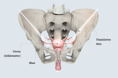 Beckenboden nach laparoskopisch-lateraler Suspension nach Dubuisson Das Bild zeigt eine anatomische Darstellung des weiblichen Beckens. Wichtige Elemente sind die Gebärmutter, die Blase und ein titanisierter Netz. Es bietet eine klare Übersicht über die Strukturen im Beckenbereich.