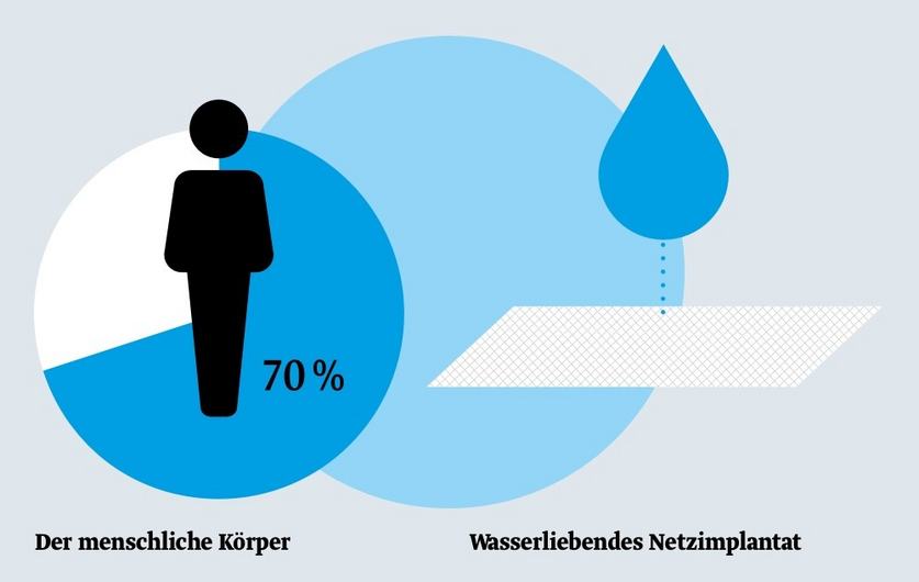 Wasserliebende (hydrophile) Oberfläche bei titansierten Netzimplantaten Eine Grafik zeigt, dass der menschliche Körper zu 70 % aus Wasser besteht. Daneben ist ein Wasser tropfendes Netzimplantat abgebildet, das die Verbindung zwischen dem menschlichen Wasseranteil und der Technologie darstellt.
