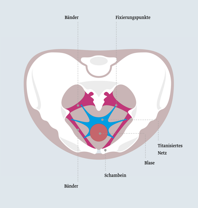 Beckenboden mit Mehrarmnetz Schematische Darstellung des menschlichen Beckens. Wichtige Strukturen wie Bänder, Fixierungspunkte, das Schambein und eine Blase sind markiert. Ein titanisiertes Netz ist ebenfalls eingezeichnet, um die anatomische Anordnung zu verdeutlichen.