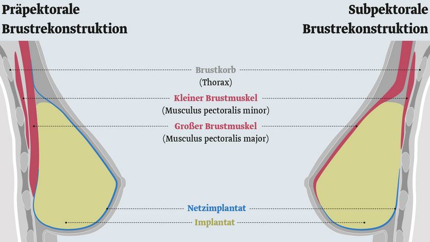 Brustrekonstruktion Information F r Patientinnen Pfm Medical Gmbh Brustrekonstruktion Information F r Patientinnen Pfm Medical Gmbh