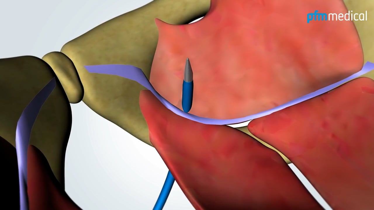 Animation: TiLOOP&reg; PLUS-System in der Zystozelenversorgung