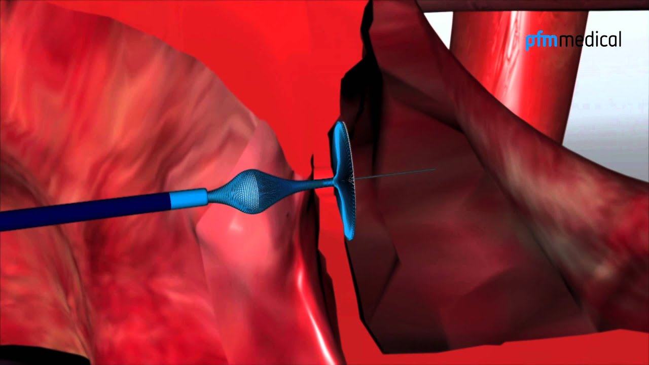 PFO Occlusion System: Nit-Occlud® PFO