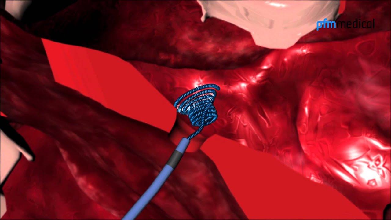 VSD Occlusion System: Nit-Occlud® Lê VSD